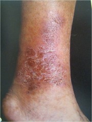 Venous Stasis Dermatitis – WinterPark Varicose Vein & Spider Vein